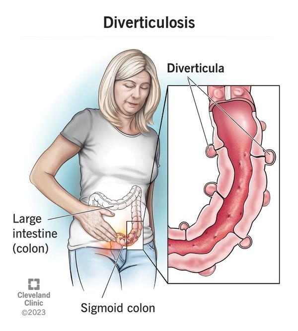 Advanced Urgent Care goal is to avoid hospitalization Acute Diverticulitis 2.jpg