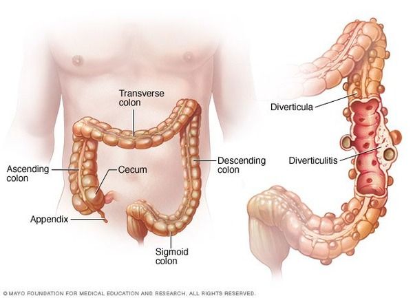 Advanced Urgent Care goal is to avoid hospitalization Acute Diverticulitis.jpg