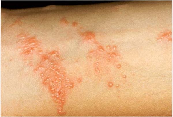 Advanced urgent care goal in treating poison IVy and urticaria.jpg