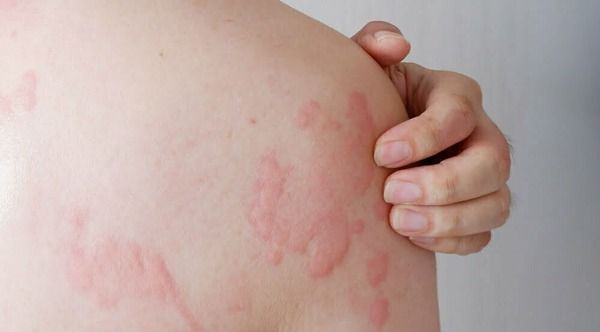 Urticaria 2.jpg