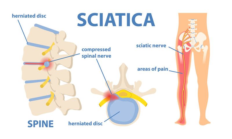 sciatica-lumbar-radiculopathy.jpg